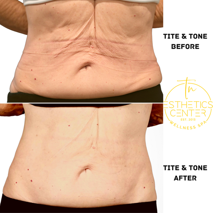 EvolveX TITE: Skin Remodeling