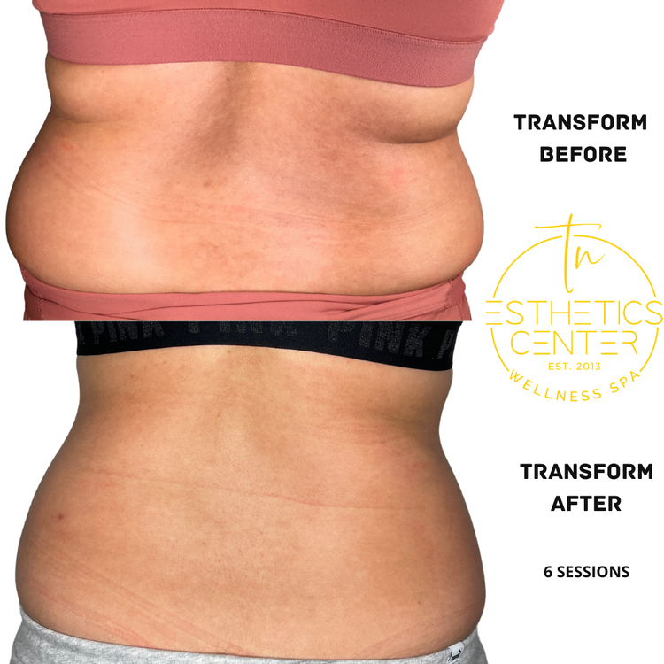 EvolveX TRANSFORM: Fat Reduction, Skin Tightening and Toning Muscle - 105 Minutes