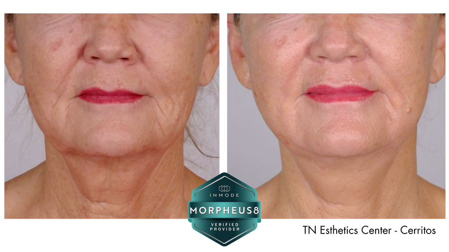 Morpheus8 Burst treatment before and after on face and neck.