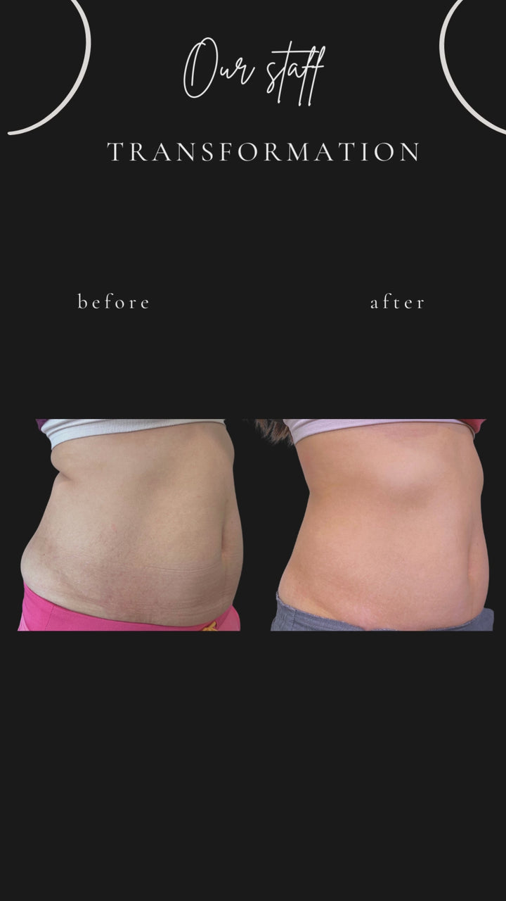 Evolve X - Body Contouring