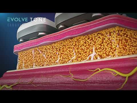 EvolveX TITE: Skin Remodeling